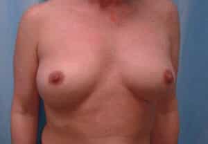 Before Image: Breast Augmentation