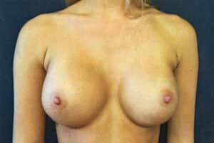After Image: Breast Augmentation