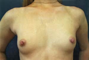 Before Image: Breast Augmentation