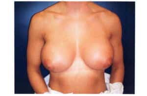After Image: Breast Augmentation