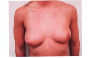 Before Image: Breast Augmentation