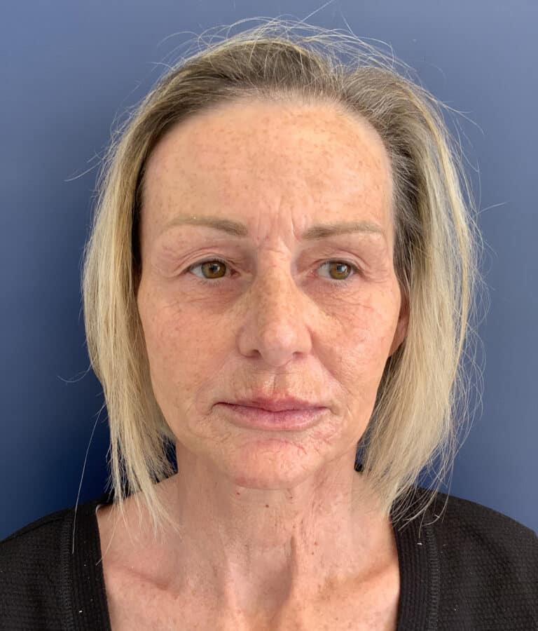 After Image: Non-surgical Facial Rejuvenation - front