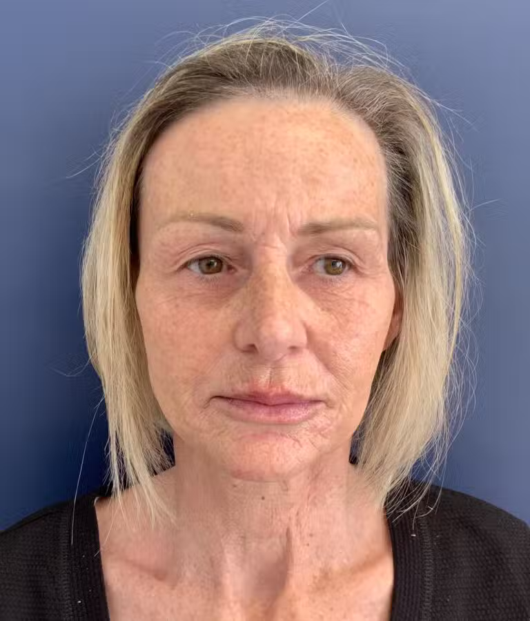 After Image: Non-surgical Facial Rejuvenation - front