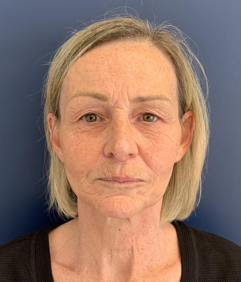Before Image: Non-surgical Facial Rejuvenation - front