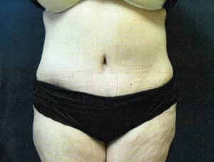 After Image: Tummy Tuck