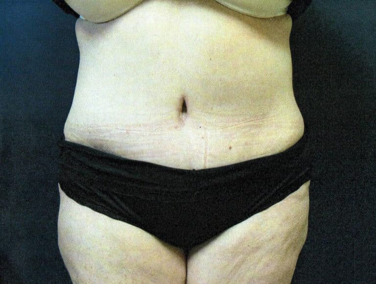 After Image: Tummy Tuck - front
