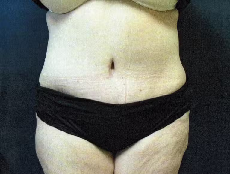 After Image: Tummy Tuck - front