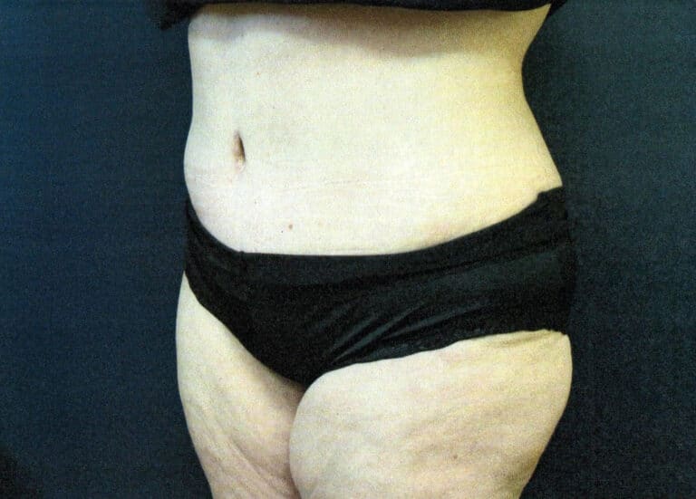 After Image: Tummy Tuck - left-front-oblique