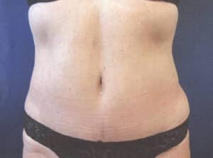 After Image: Tummy Tuck