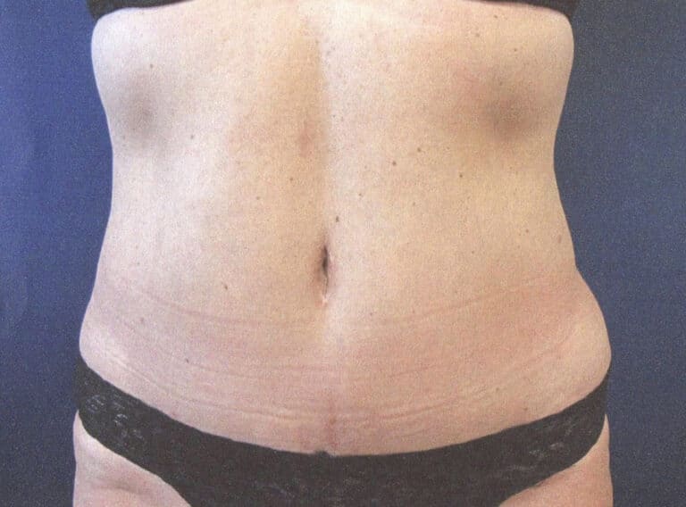 After Image: Tummy Tuck - front