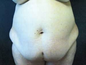 Before Image: Tummy Tuck