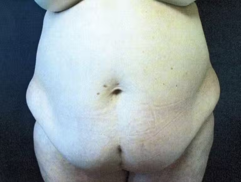 Before Image: Tummy Tuck - front
