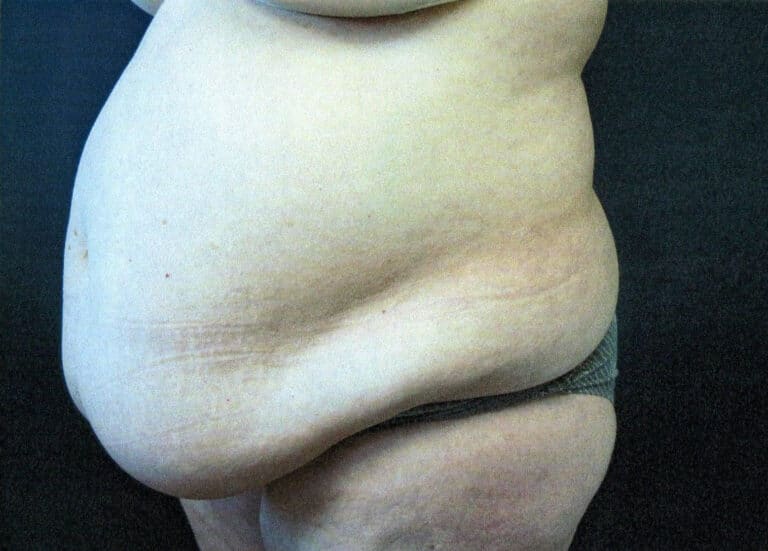 Before Image: Tummy Tuck - left-front-oblique