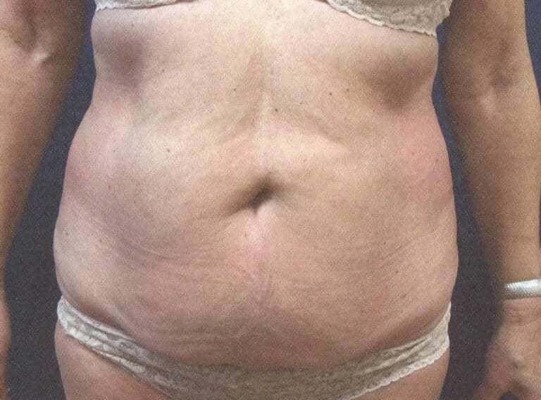 Before Image: Tummy Tuck - front
