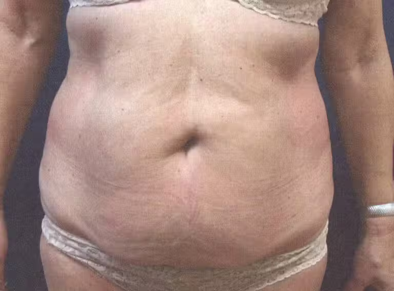 Before Image: Tummy Tuck - front