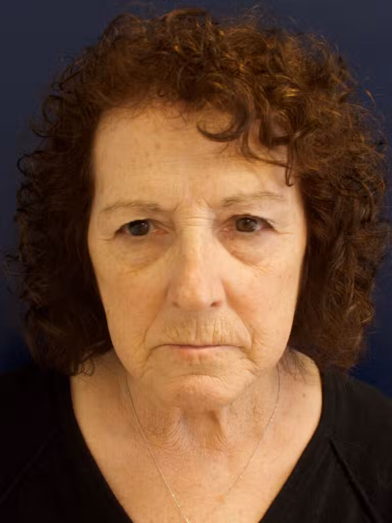 Before Image: Facial Rejuvenation - front