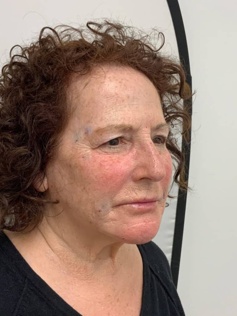 After Image: Facial Rejuvenation -