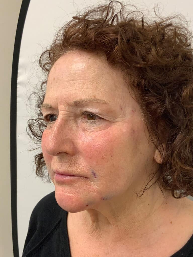After Image: Facial Rejuvenation -