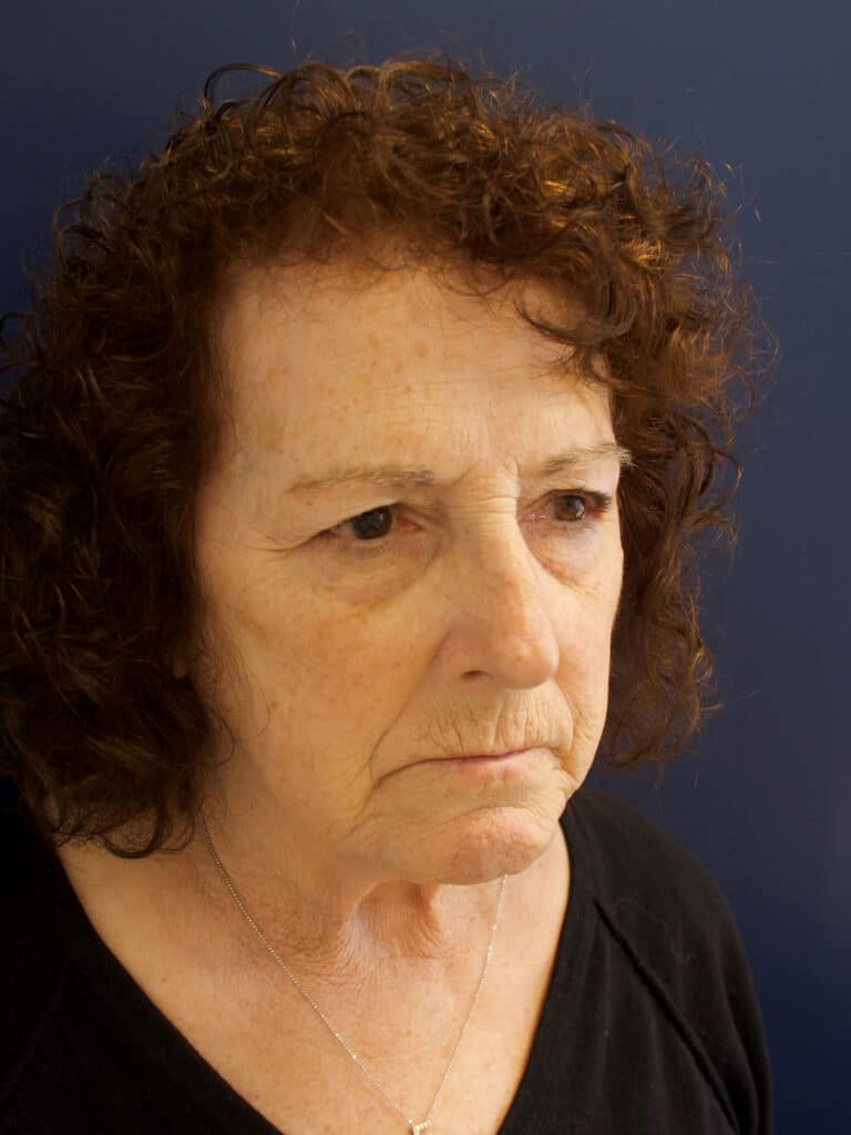 Before Image: Facial Rejuvenation -