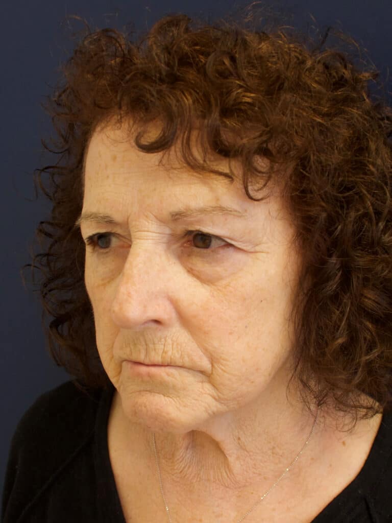 Before Image: Facial Rejuvenation -