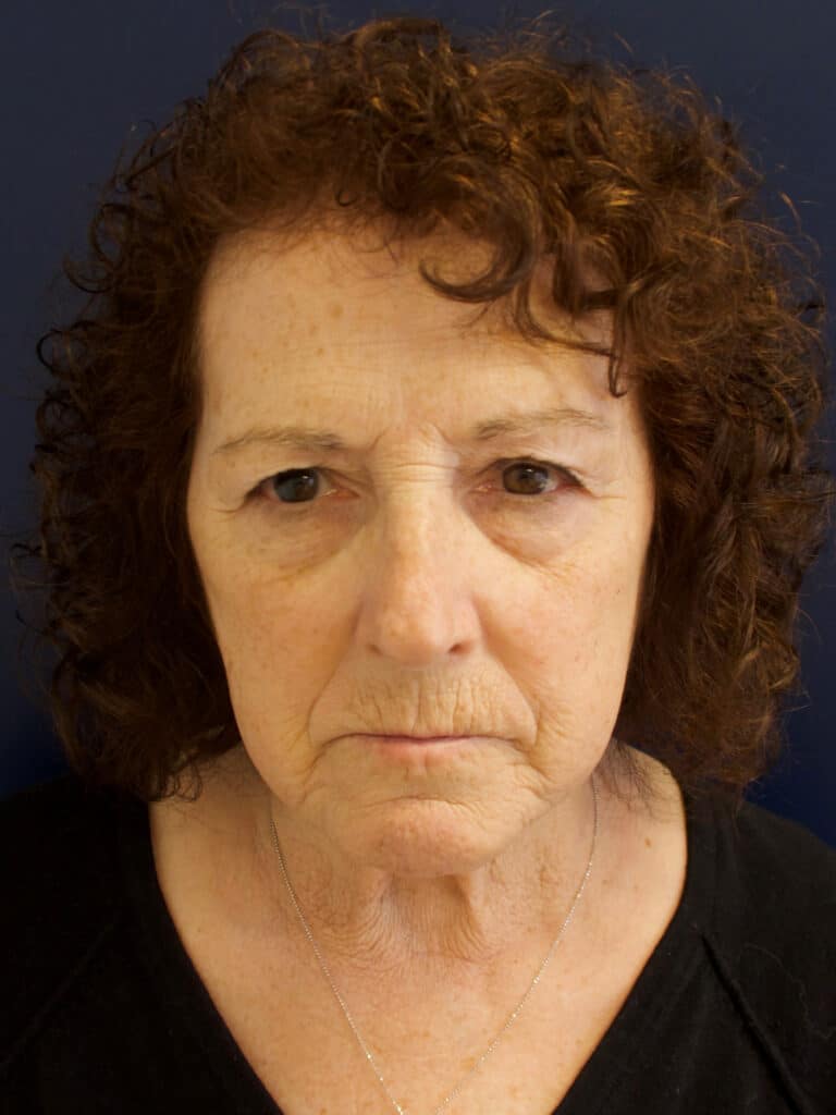 Before Image: Facial Rejuvenation - front