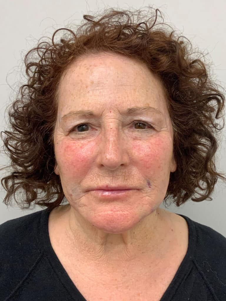 After Image: Facial Rejuvenation - front