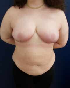 After Image: Breast Reduction