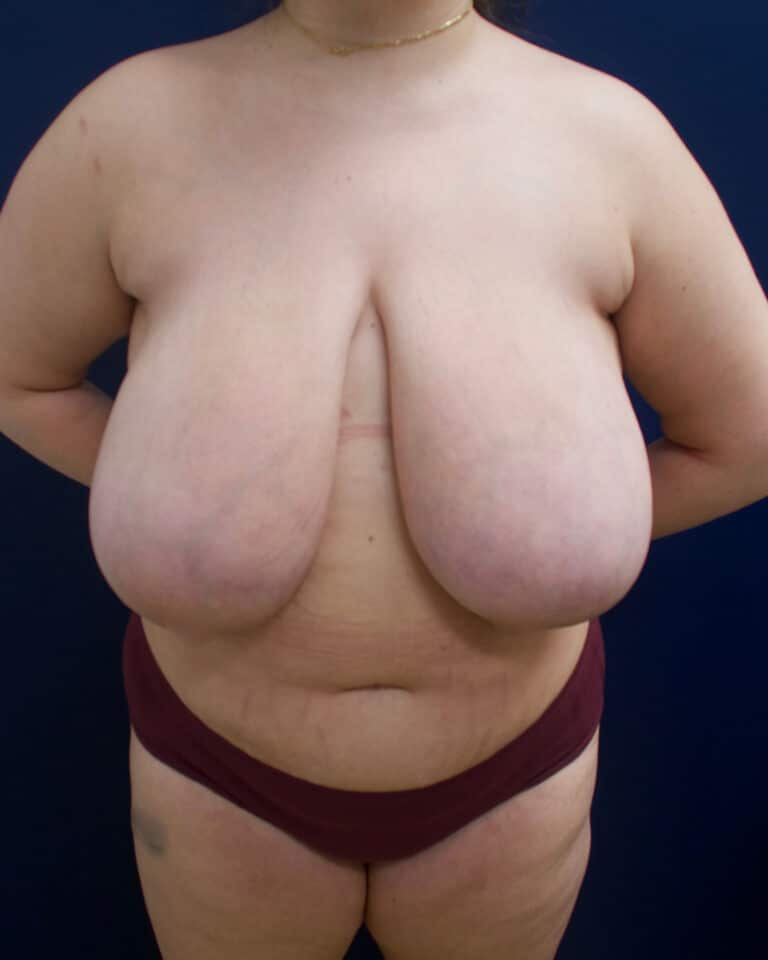 Before Image: Breast Reduction - front