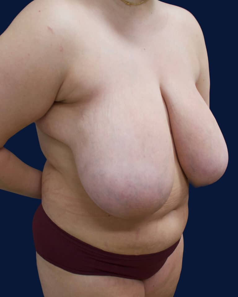 Before Image: Breast Reduction - right-front-oblique