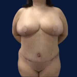 After Image: Bilateral Breast Reduction, Tummy Tuck, and Liposuction 360
