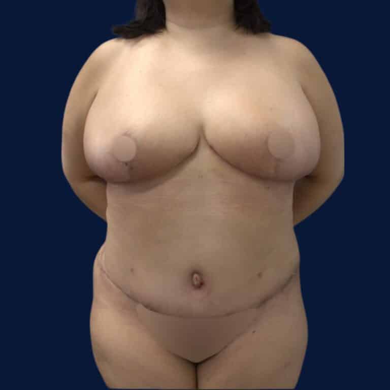 After Image: Bilateral Breast Reduction, Tummy Tuck, and Liposuction 360 - front