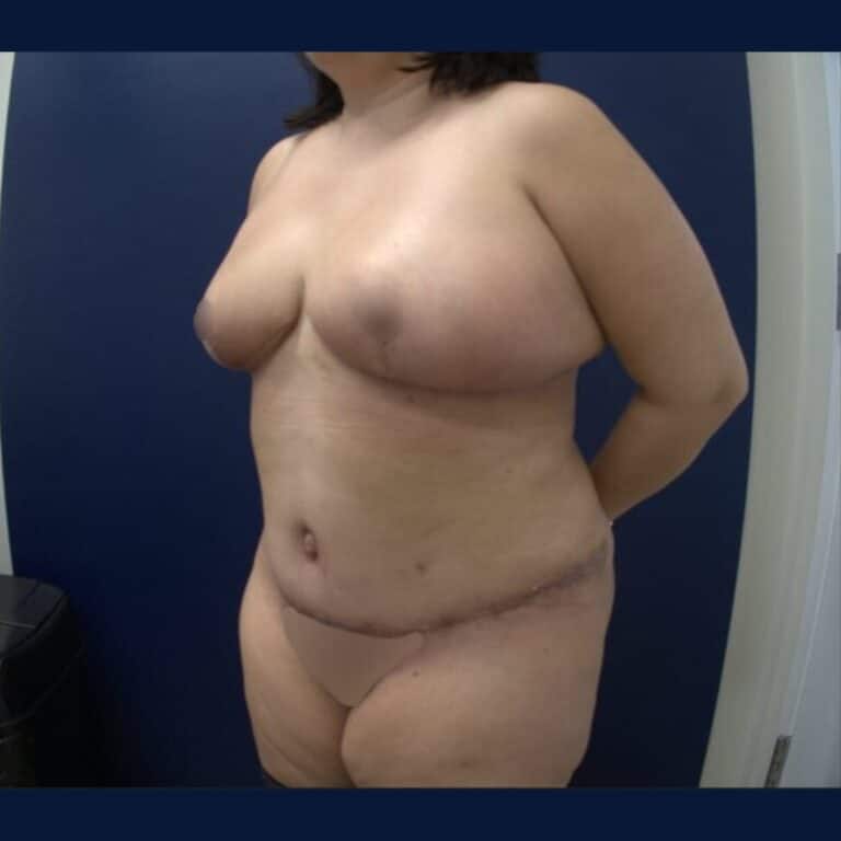After Image: Bilateral Breast Reduction, Tummy Tuck, and Liposuction 360 - left-front-oblique