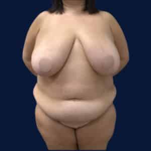 Before Image: Bilateral Breast Reduction, Tummy Tuck, and Liposuction 360
