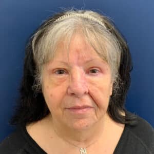 After Image: Bilateral Upper Blepharoplasty