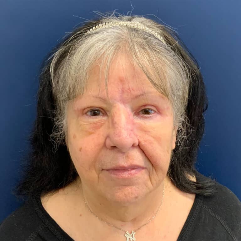 After Image: Bilateral Upper Blepharoplasty - front