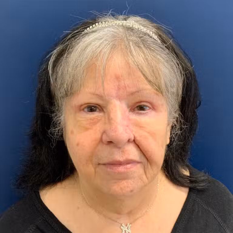 After Image: Bilateral Upper Blepharoplasty - front