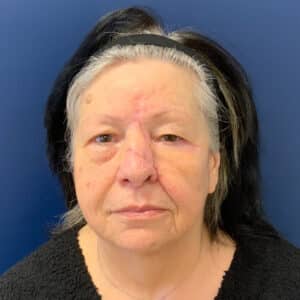 Before Image: Bilateral Upper Blepharoplasty