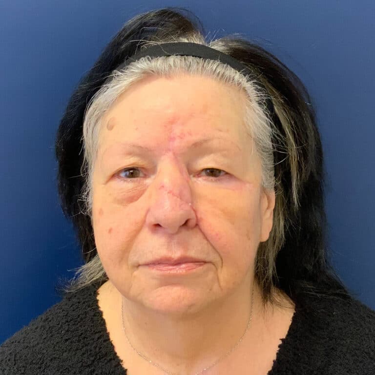 Before Image: Bilateral Upper Blepharoplasty - front
