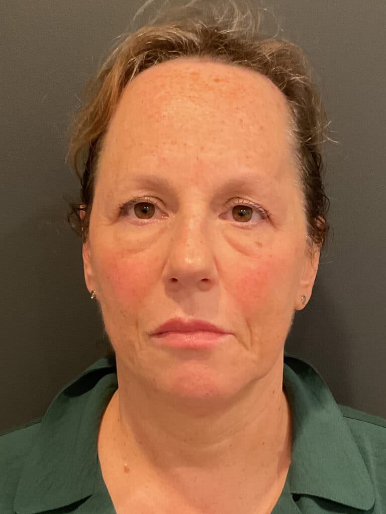 After Image: T-Shape 2 - front