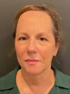 Before Image: T-Shape 2