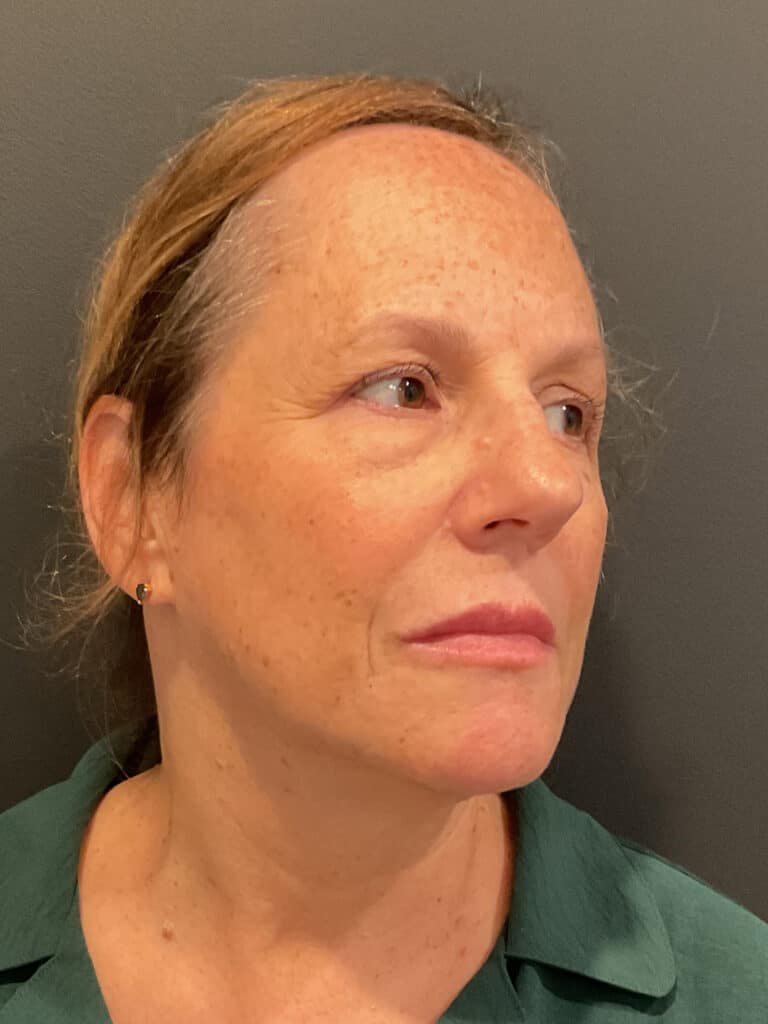 Before Image: T-Shape 2 - right-front-oblique