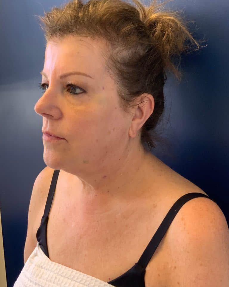 Before Image: T-Shape 2 - left-front-oblique